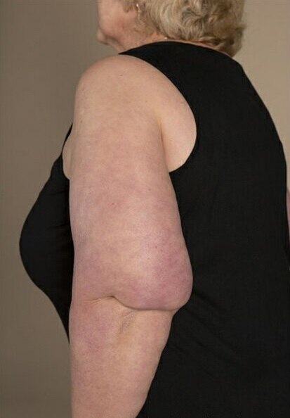 Photo of a woman facing side-on, wearing a black sleeveless shirt with abnormal fat deposit at back of her elbow 