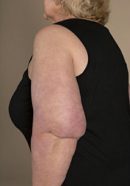 Photo of a woman facing side-on, wearing a black sleeveless shirt with abnormal fat deposit at back of her elbow 