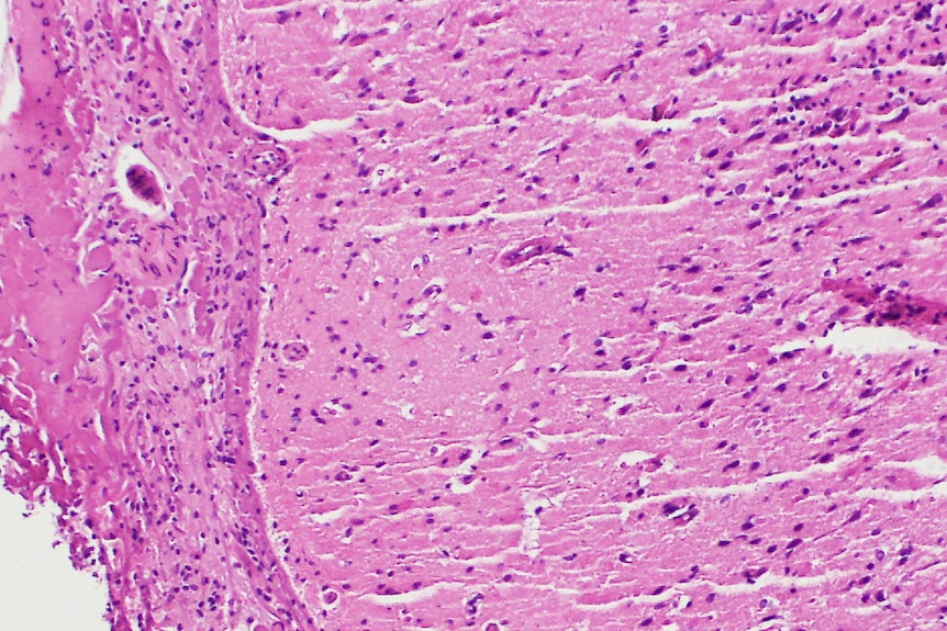 Microscopic image showing inflammation of the brain meninges