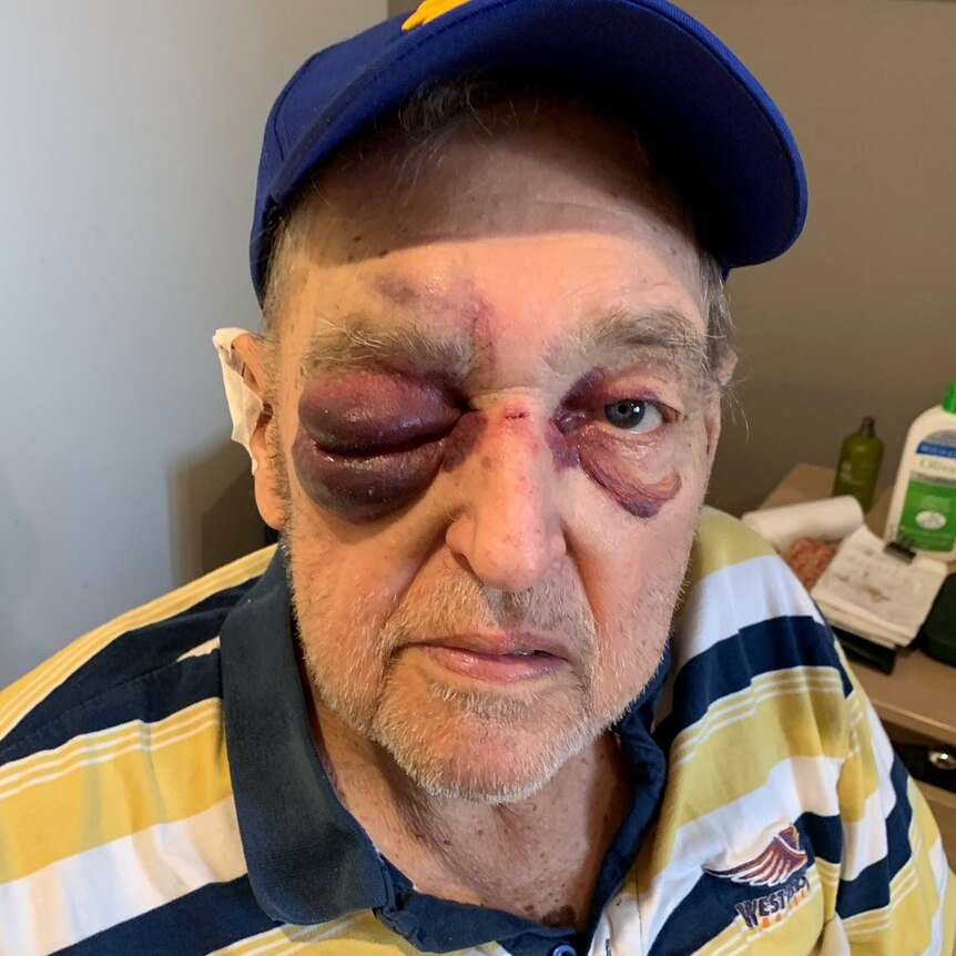 An older man wiht severely swollen eyes.