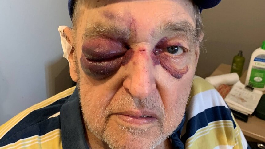 An older man wiht severely swollen eyes.