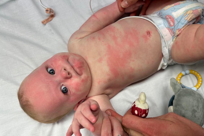 a baby in a nappy, covered in hives