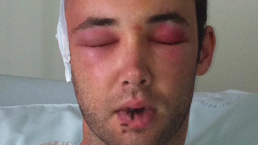 Simon Cramp was seriously injured after being bashed in Sydney's CBD in June last year.