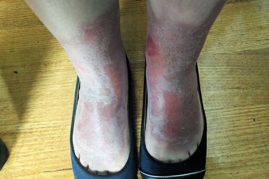 A woman's deep red, sunburnt feet