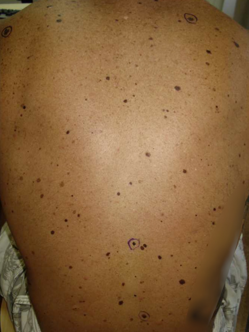 tanning injections melanotan fail Dermatologists are warning against the viral Barbie drug (Melanotan II/MTII), saying the unregulated peptide can come with side effects like nausea, facial flushing, sexual side effects, and even injection-site abscesses Melanotan What It Is