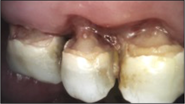 Teeth in a mouth showing decay