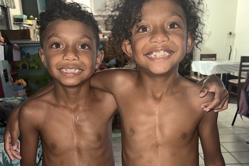 Two young boys without shirts on to show the scars on their chests from open heart surgery.