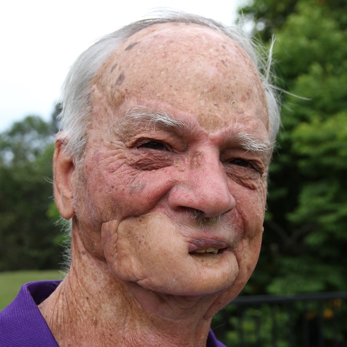 A man's face with a disfigured jaw