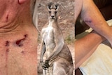 a grey kangaroo stands in a collage of photos of scratches received by an elderly man