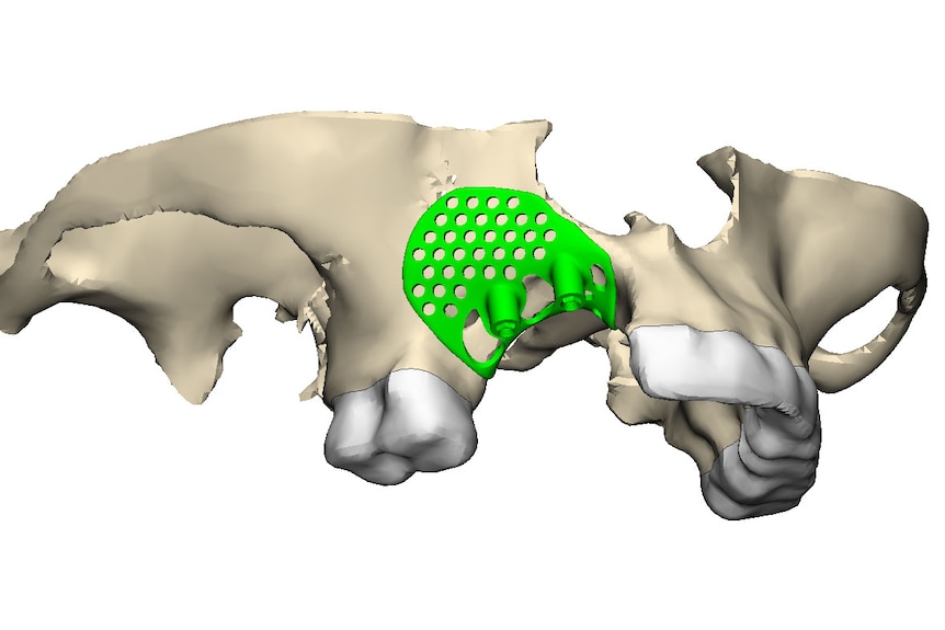 A scan of Susie Robinson's jaw with the 3D printed implant