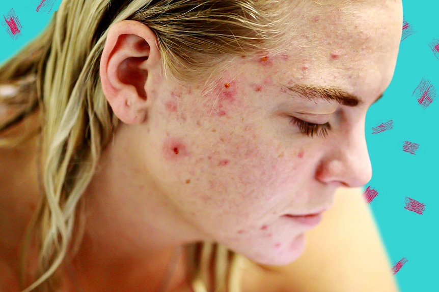 Woman with acne on face.