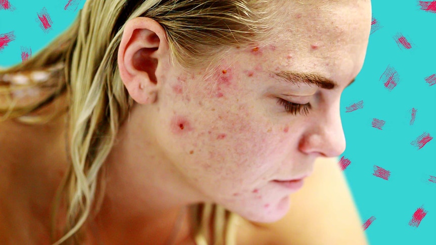 Woman with acne on face for an explainer on acne, its causes, treatments, its diet link, and treating scarring.