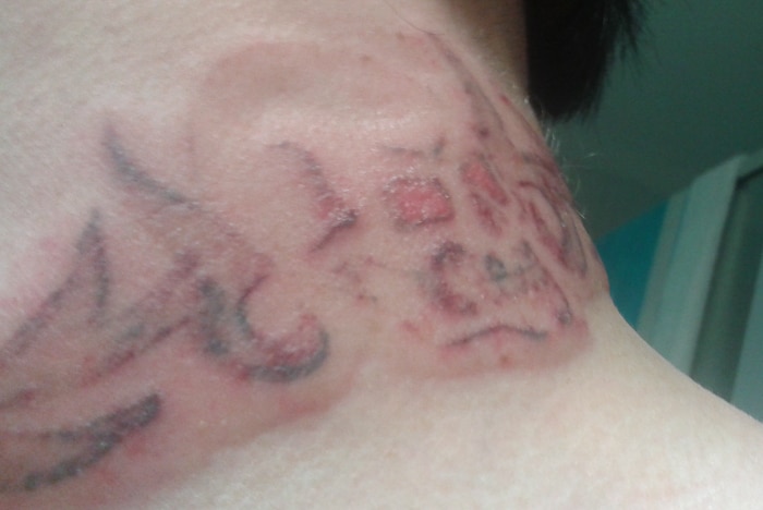 Clinton Trestrail's neck after laser treatment.