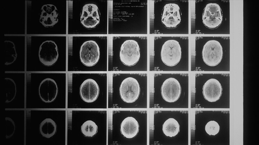 Head x-rays taken by CAT scanner.