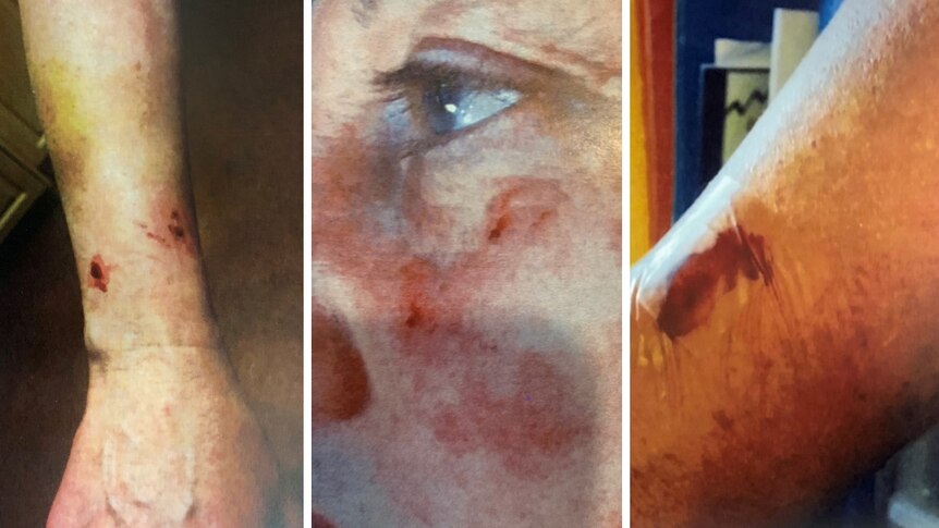 A composite photo of scratches and bite marks on a woman's face and arms.