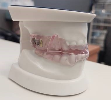 a mouth splint for obstructive sleep apnoea on a cast