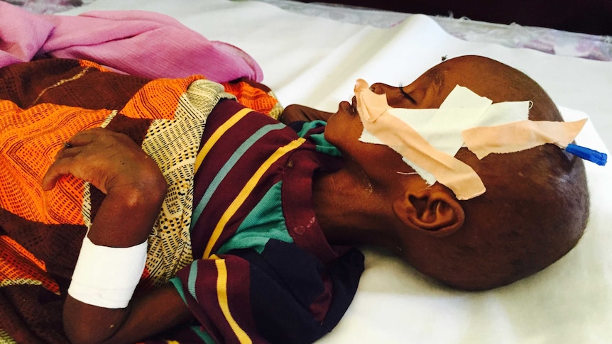 Child suffering from malnutrition in Somaliland