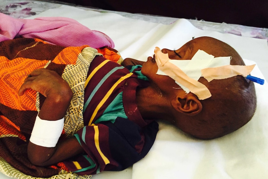 Child suffering from malnutrition in Somaliland