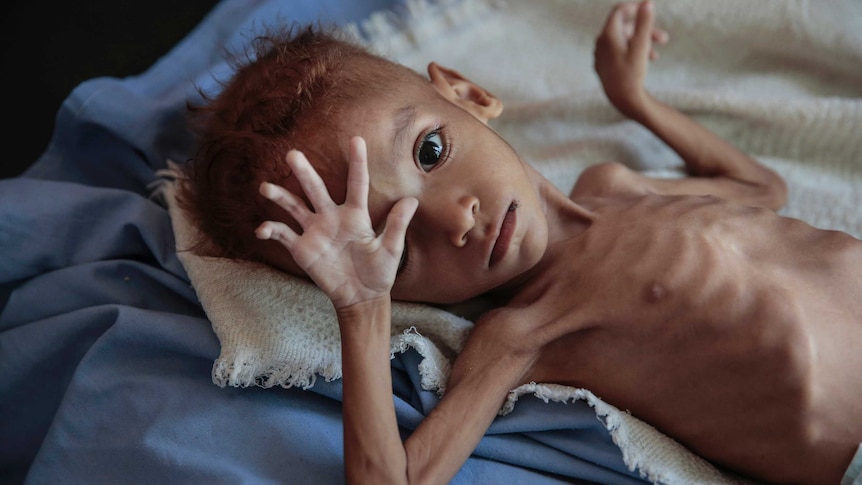 A severely malnourished boy rests on a hospital bed at the Aslam Health Centre, Hajjah, Yemen