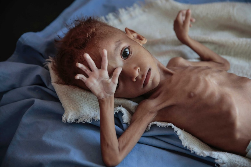 A severely malnourished boy rests on a hospital bed at the Aslam Health Centre, Hajjah, Yemen
