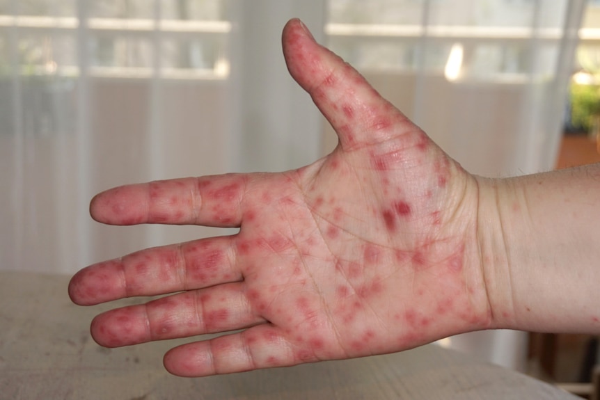 A close-up shot of a hand of a person infected with hand, foot and mouth disease.