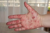 A close-up shot of a hand of a person infected with hand, foot and mouth disease.