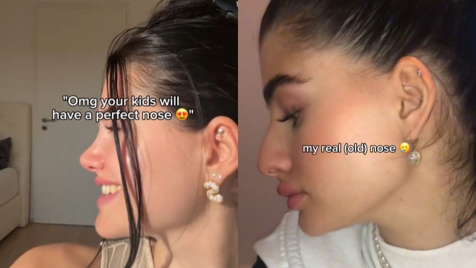 Uma imagem composta de uma mulher antes e depois da cirurgia no nariz.