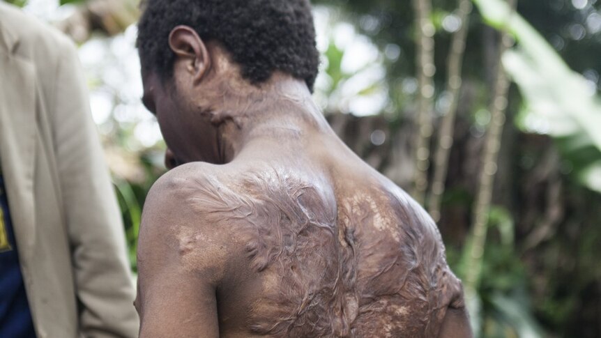 Senny's back, arms and neck are covered in severe burns. A house he was sheltering in was attacked with a grenade.
