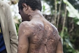 Senny's back, arms and neck are covered in severe burns. A house he was sheltering in was attacked with a grenade.