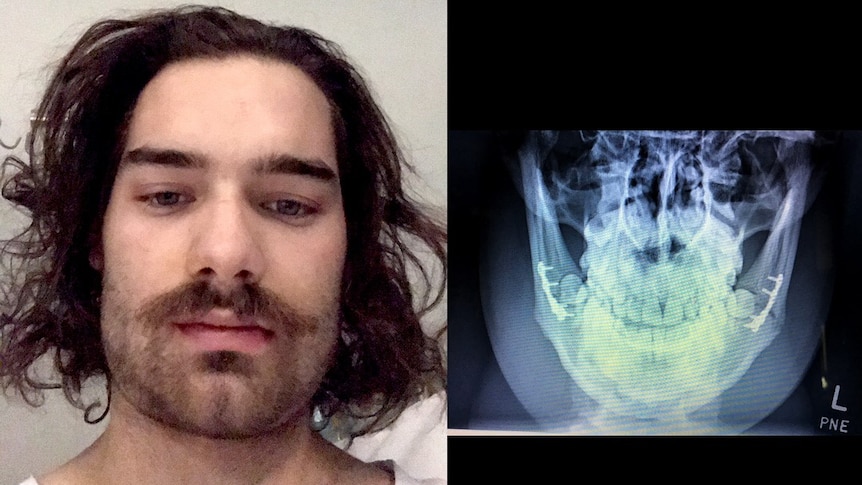 Edited picture of man in hospital shown with x-ray of his broken jaw