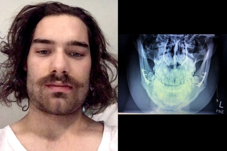 Edited picture of man in hospital shown with x-ray of his broken jaw