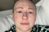 Jodie Leworthy with shaved head lying in a hospital bed with a tear rolling down her right cheek.