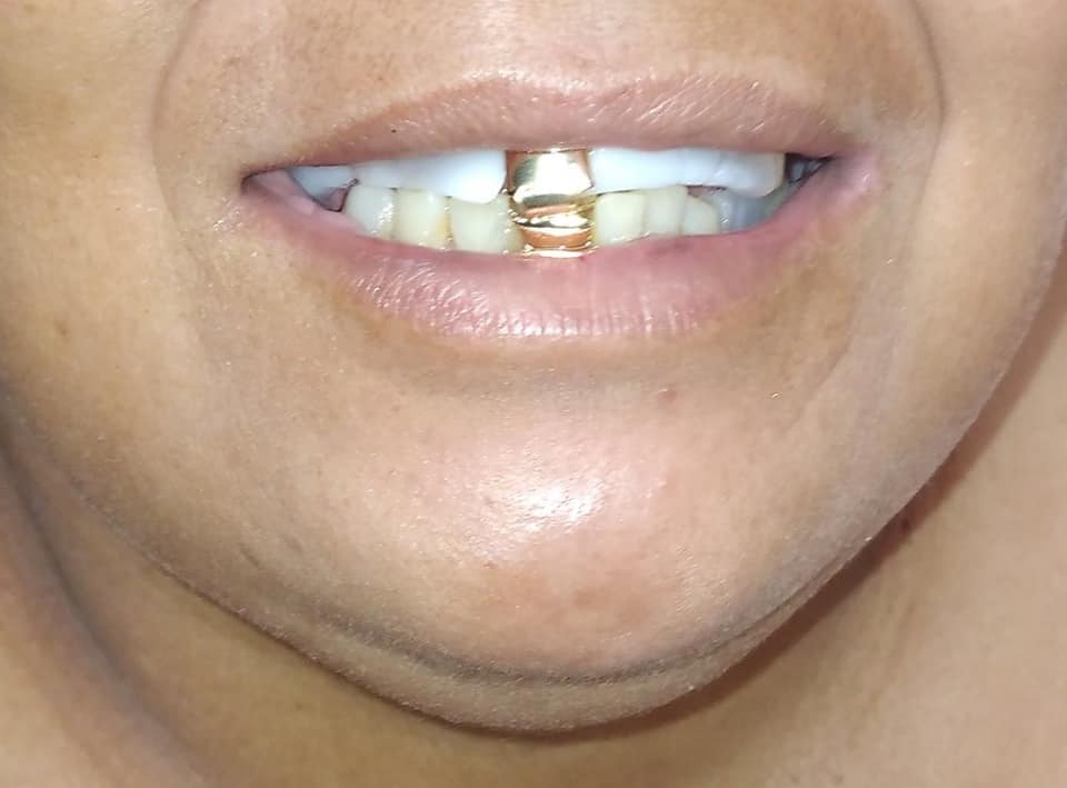 The mouth of a woman with two fake gold teeth.  