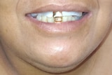 The mouth of a woman with two fake gold teeth.  