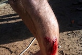 Shark attack injury
