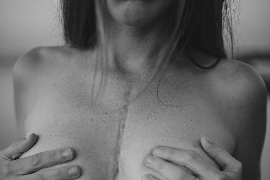 Black and white photo of woman showing off scar on chest