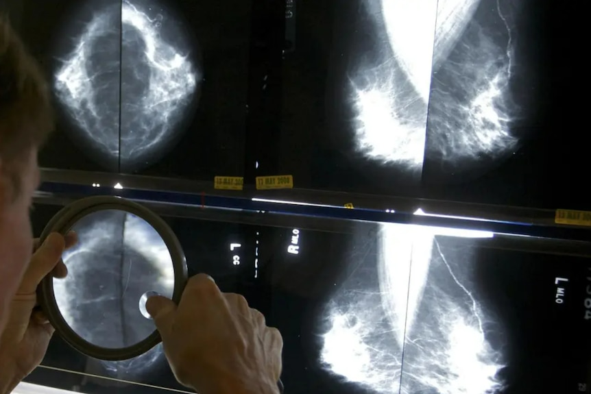 A radiologist uses a magnifying glass to check mammograms for breast cancer