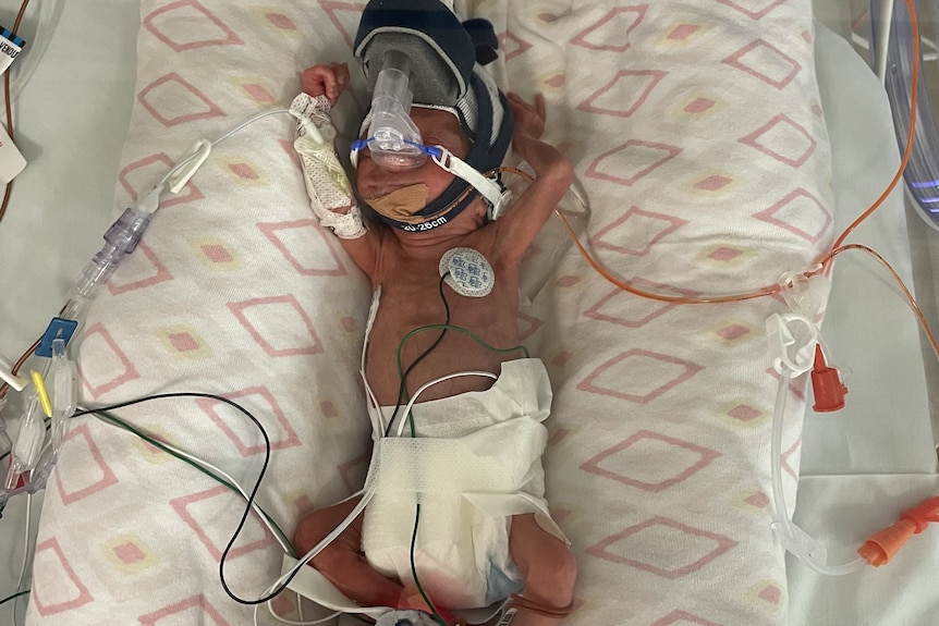 A tiny baby girl hooked up to tubes in a neonatal intensive care unit