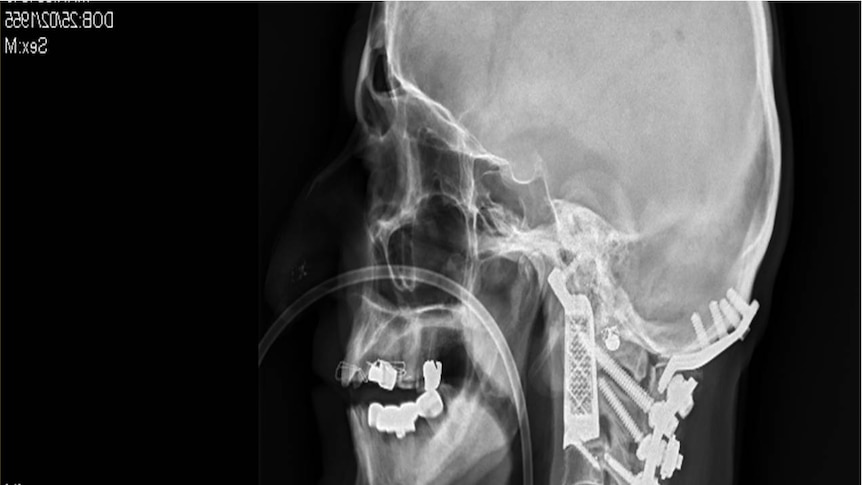 X-ray shows Drage Josevski's top two vertebrae