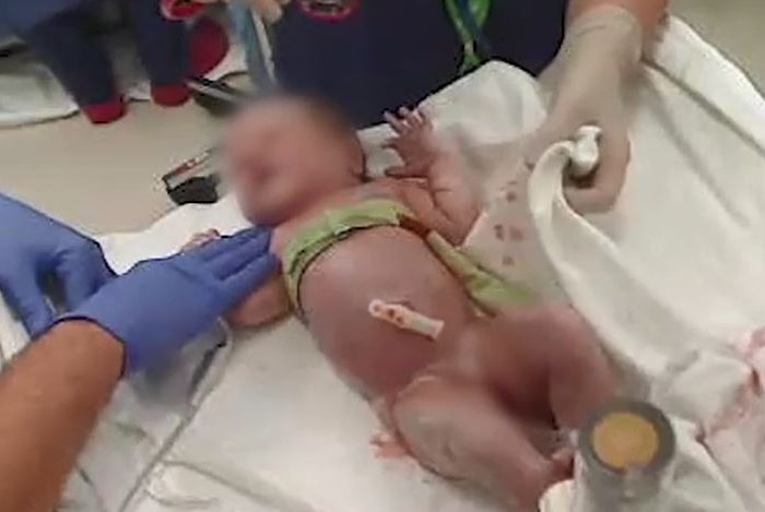 A newborn baby with a green silk strap around its chest, surrounded by medical staff.