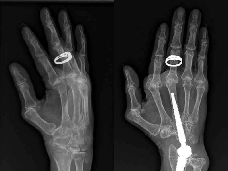 side by side x-rays of a wrist, one with a piece of metal from surgery