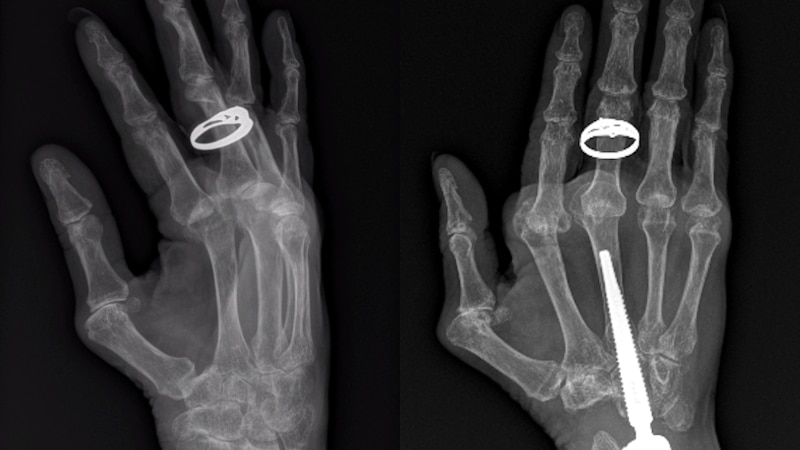 side by side x-rays of a wrist, one with a piece of metal from surgery