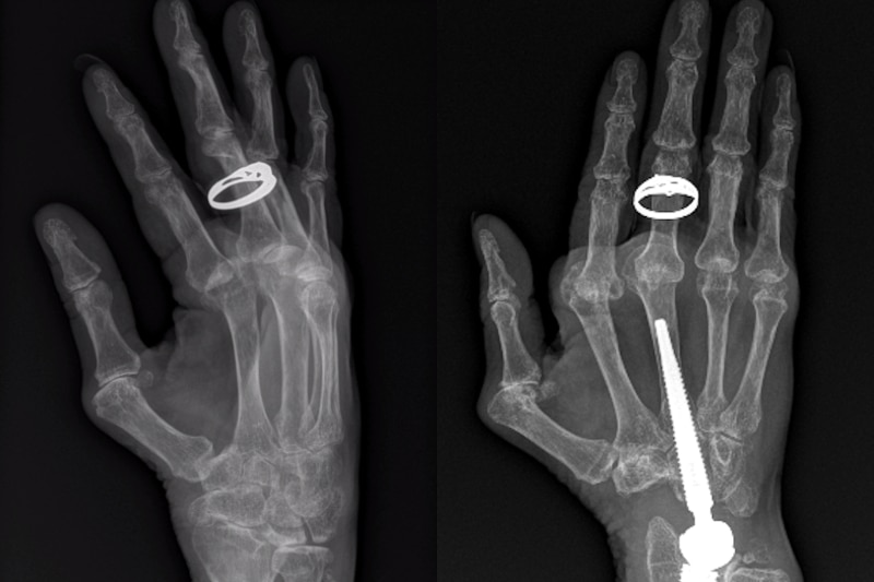 side by side x-rays of a wrist, one with a piece of metal from surgery
