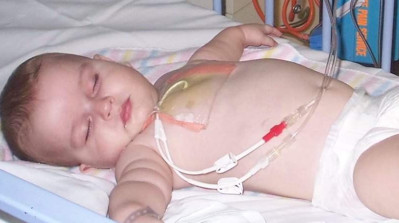 Baby Harrison Draper has Severe Combined Immune Deficiency.