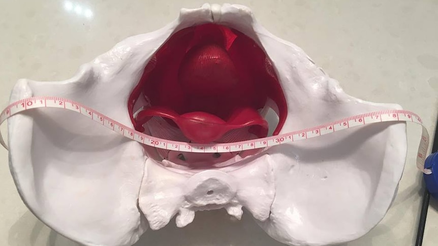 A model of a pelvic mesh implant.
