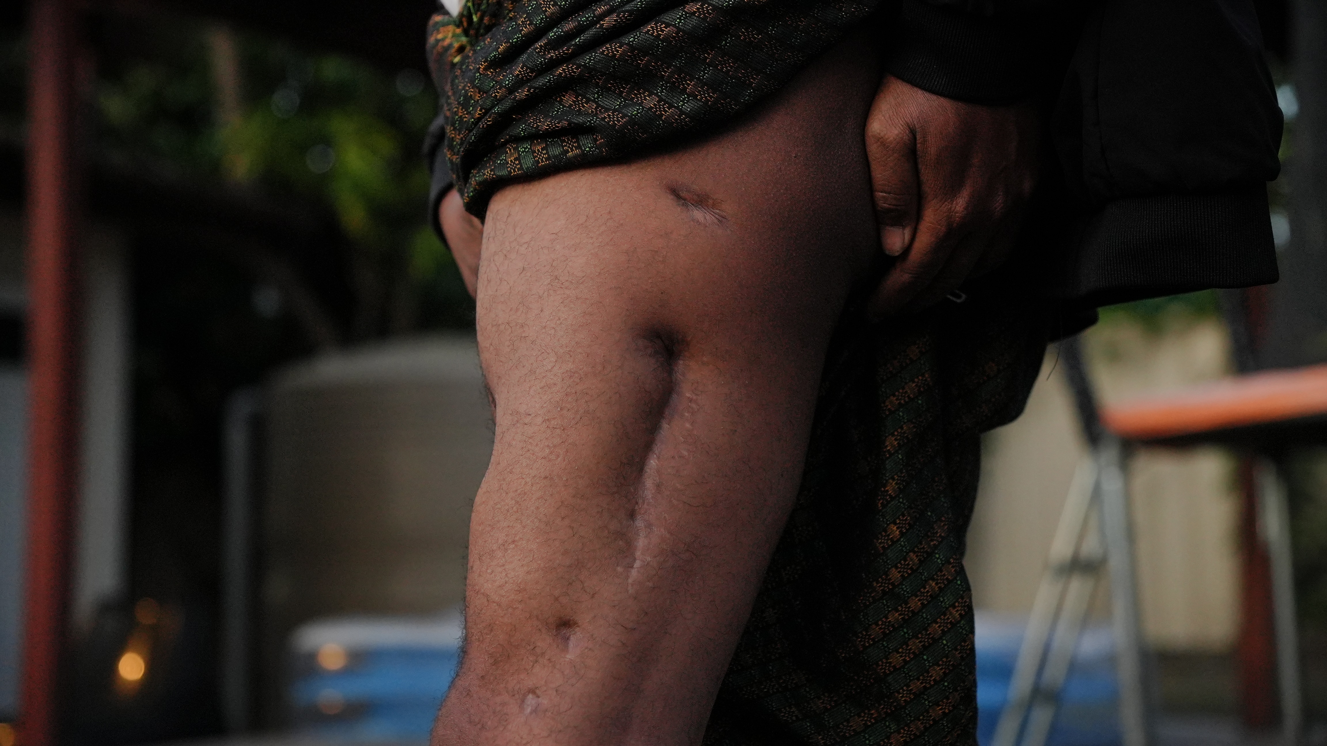Close-up of a man's leg with scars from bullet wounds.