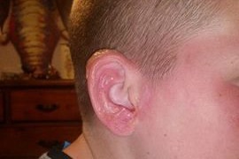 Hunter's sunburnt ear