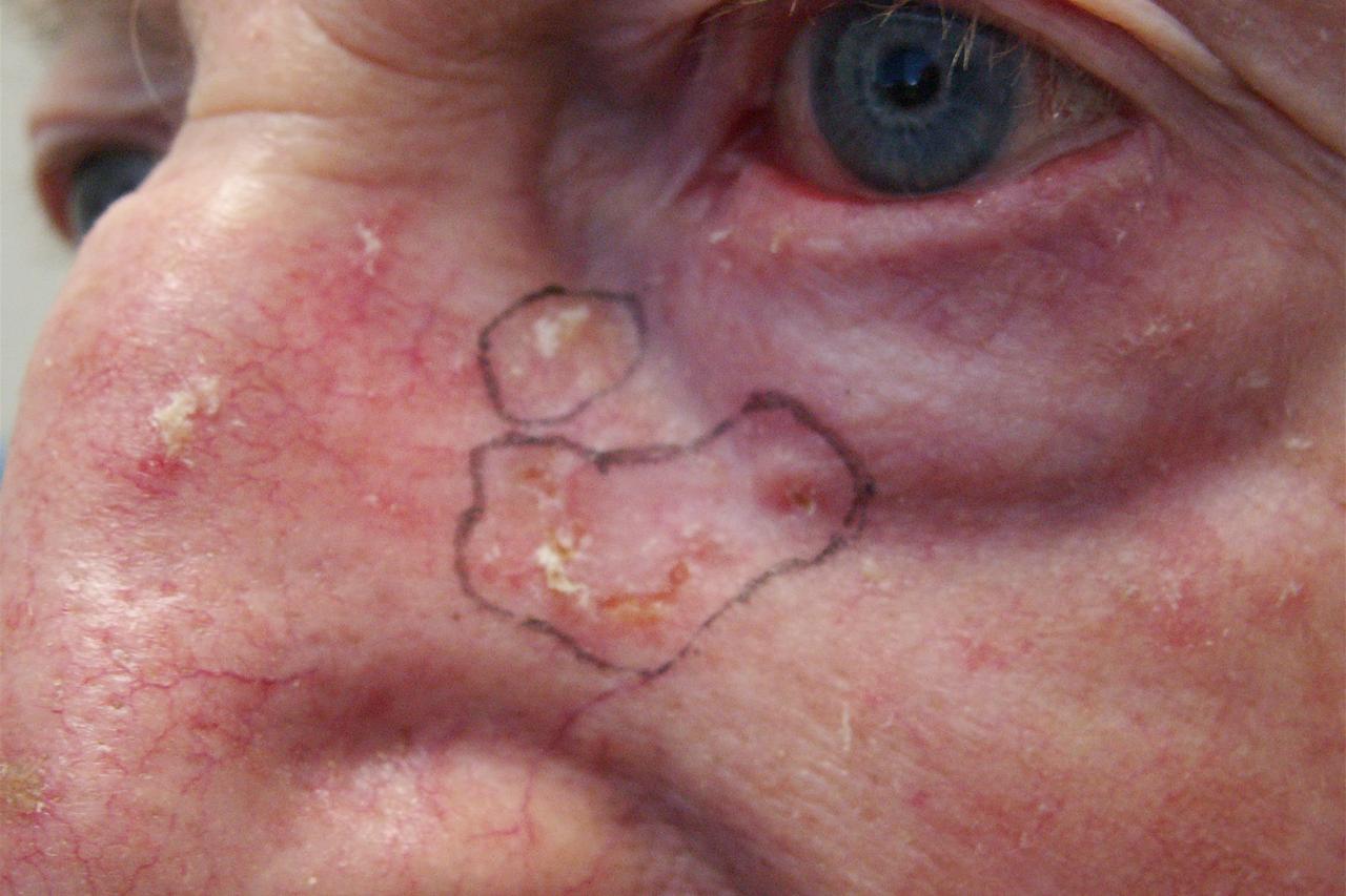 Non-melanoma cancer rates rising as population ages