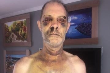 A prison officer with serious bruising and swelling to his face.