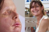 Face transplant recipient Charla Nash after her surgery (left), and before she was mauled by a chimpanzee in 2009